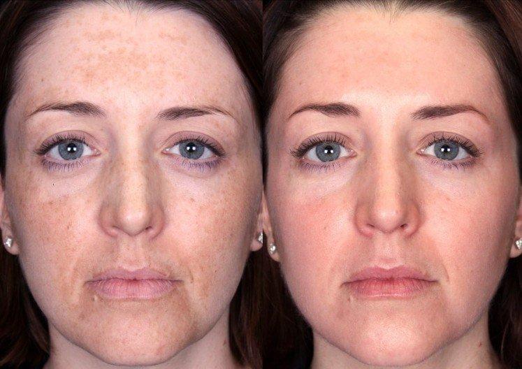 Для чего это нужно - Пилинг для лица в домашних условиях