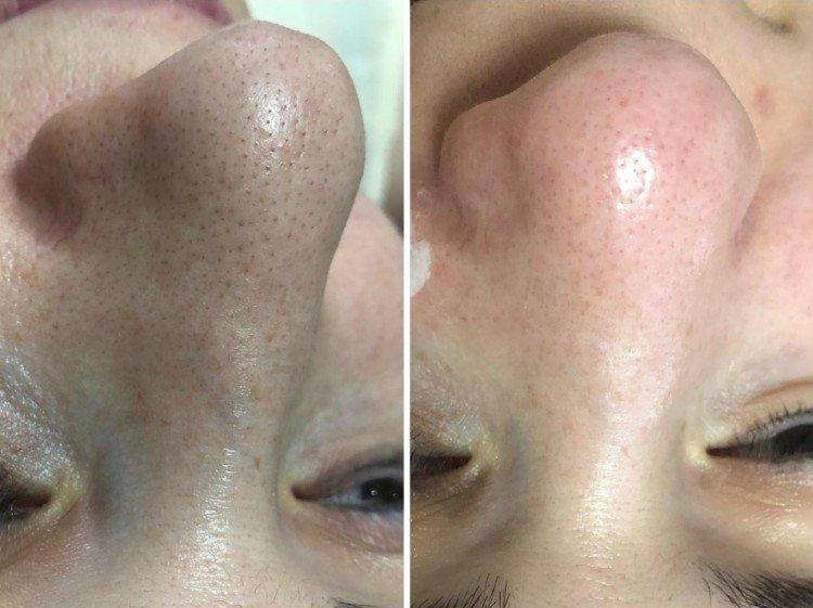 Ультразвуковая чистка лица - фото до и после