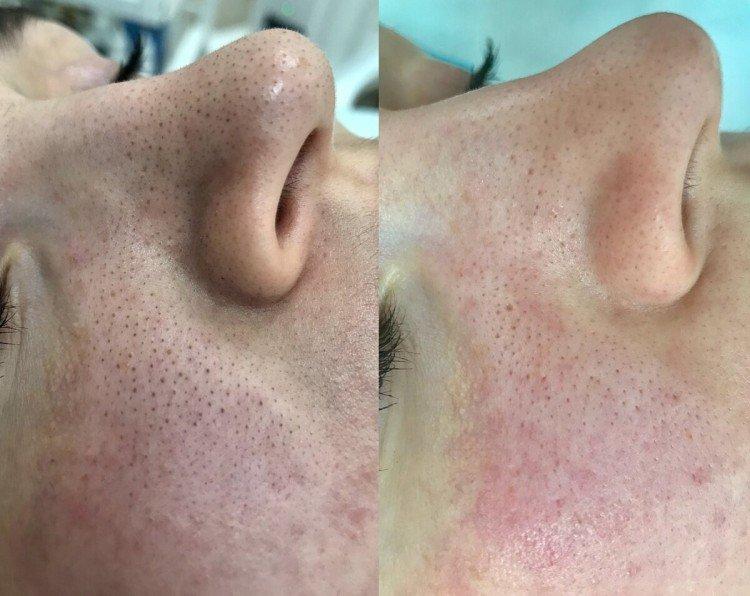 Ультразвуковая чистка лица - фото до и после